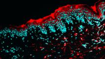 Microscope view of human skin treated with a short interfering RNA (siRNA) drug