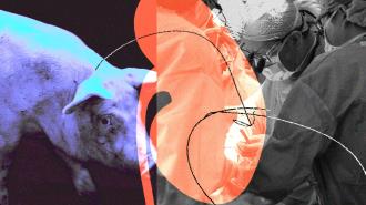 Abstract collage of a kidney, a pig, and surgeons