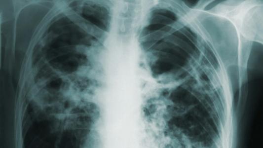 X-ray image of a human chest showing lungs and rib cage, with visible abnormal dark patches indicating possible tuberculosis.